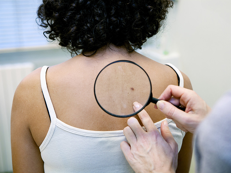 Melanoma Symptoms, Diagnosis, Treatment